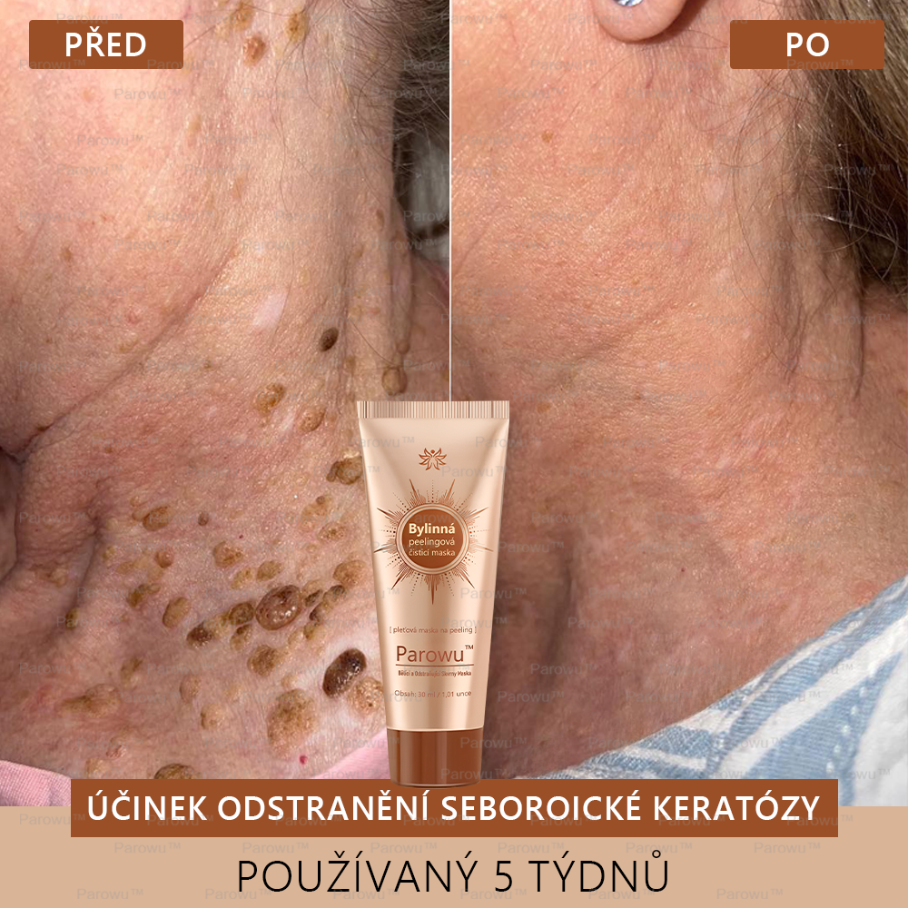 Parowu™ Bělící a Odstraňující Skvrny Maska -🍀Přírodní složky trvale odstraňují pigmentové skvrny, stařecké skvrny, pihy a sluneční skvrny🔥