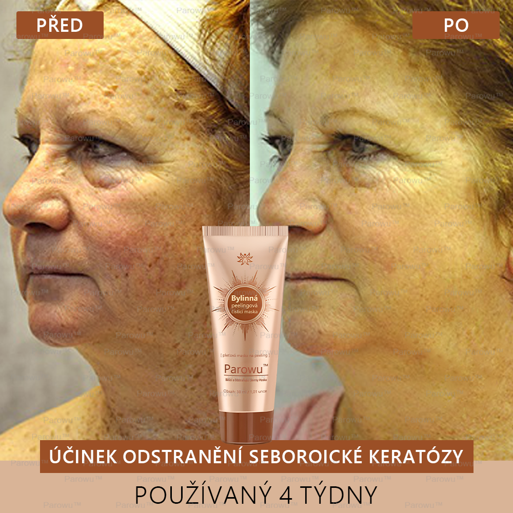 Parowu™ Bělící a Odstraňující Skvrny Maska -🍀Přírodní složky trvale odstraňují pigmentové skvrny, stařecké skvrny, pihy a sluneční skvrny🔥