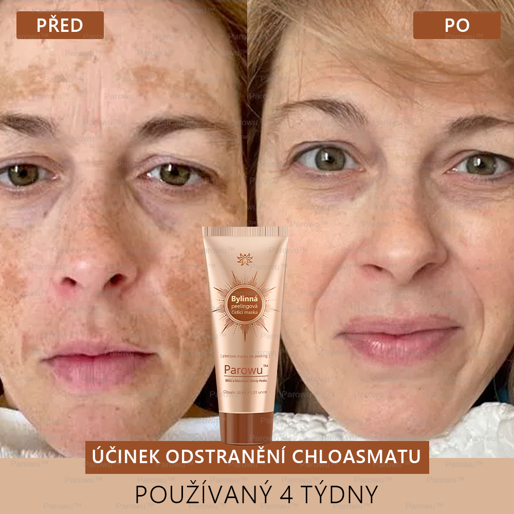 Parowu™ Bělící a Odstraňující Skvrny Maska -🍀Přírodní složky trvale odstraňují pigmentové skvrny, stařecké skvrny, pihy a sluneční skvrny🔥
