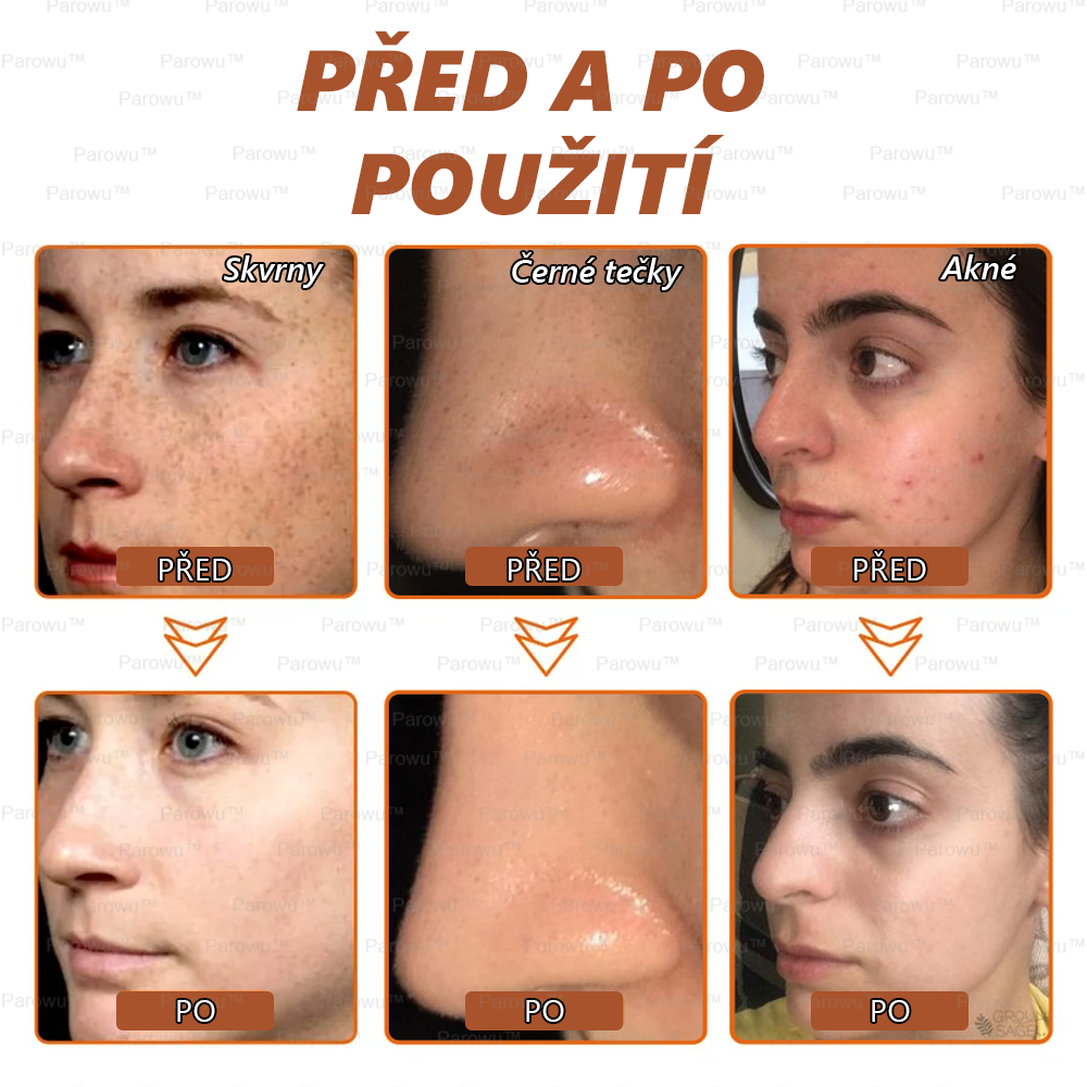 Parowu™ Bělící a Odstraňující Skvrny Maska -🍀Přírodní složky trvale odstraňují pigmentové skvrny, stařecké skvrny, pihy a sluneční skvrny🔥