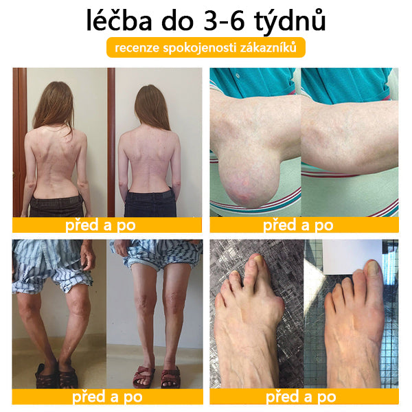 ADNOON™ Krém s botulotoxinem a včelím jedem pro úlevu od bolesti a regeneraci kostí 🐝