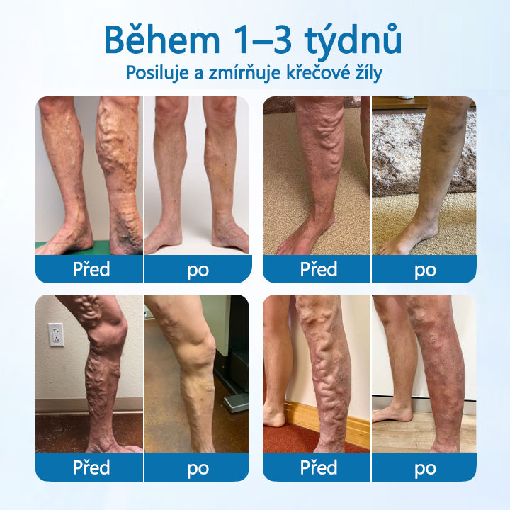 Timilk® VeinGuard bylinný sprej-✅ Klinicky prokázáno, že odstraňuje křečové žíly za pouhých 7 dní!⭐️