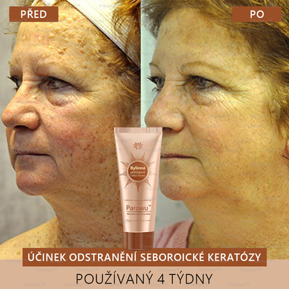 Parowu™ Bělící a Odstraňující Skvrny Maska -🍀Přírodní složky trvale odstraňují pigmentové skvrny, stařecké skvrny, pihy a sluneční skvrny🔥