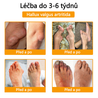ADNOON™ Krém s botulotoxinem a včelím jedem pro úlevu od bolesti a regeneraci kostí 🐝